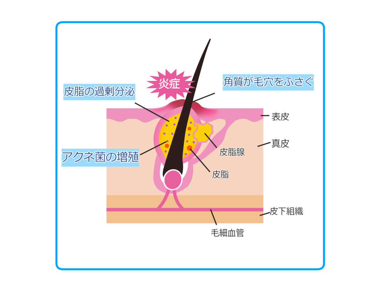 ニキビの断面図